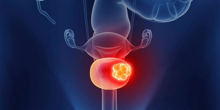 Carcinoma In Situ of the Urinary Bladder