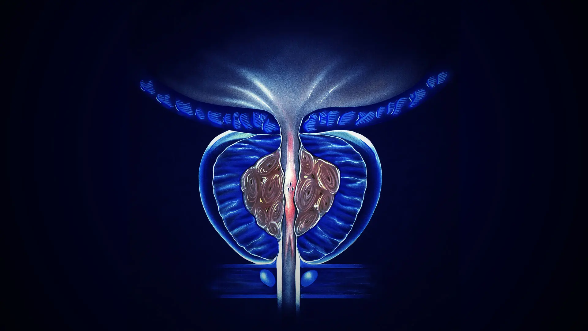 Benign Prostatic Enlargement (BPE)